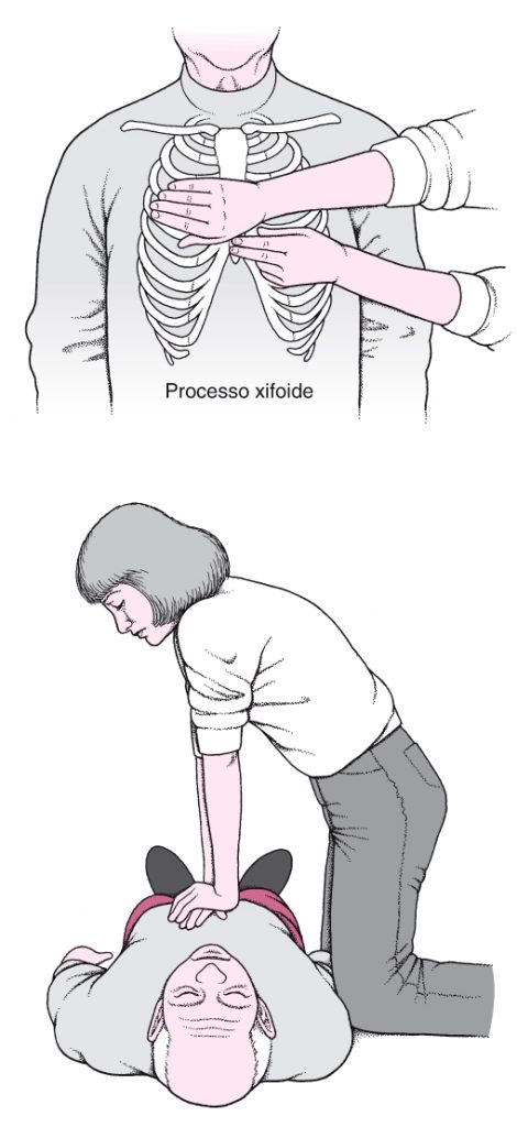 Ilustrações mostrando o processo de RCP em uma parada cardiorrespiratória