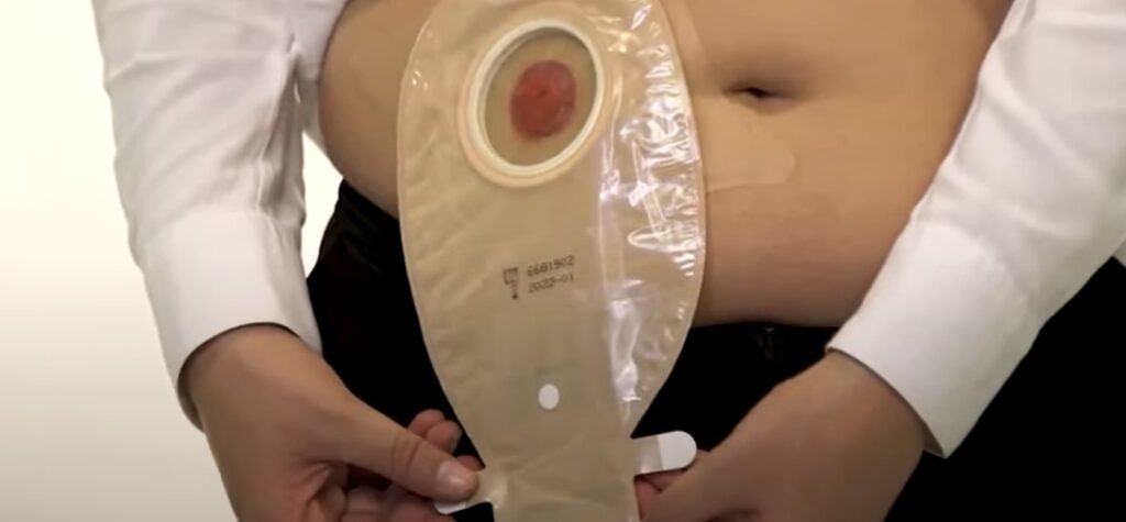 bolsa colostomia