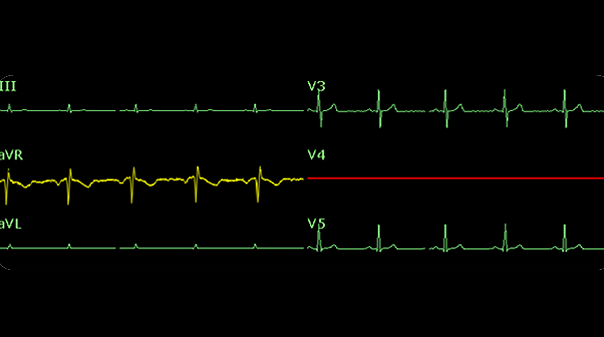 ecg edan imagem